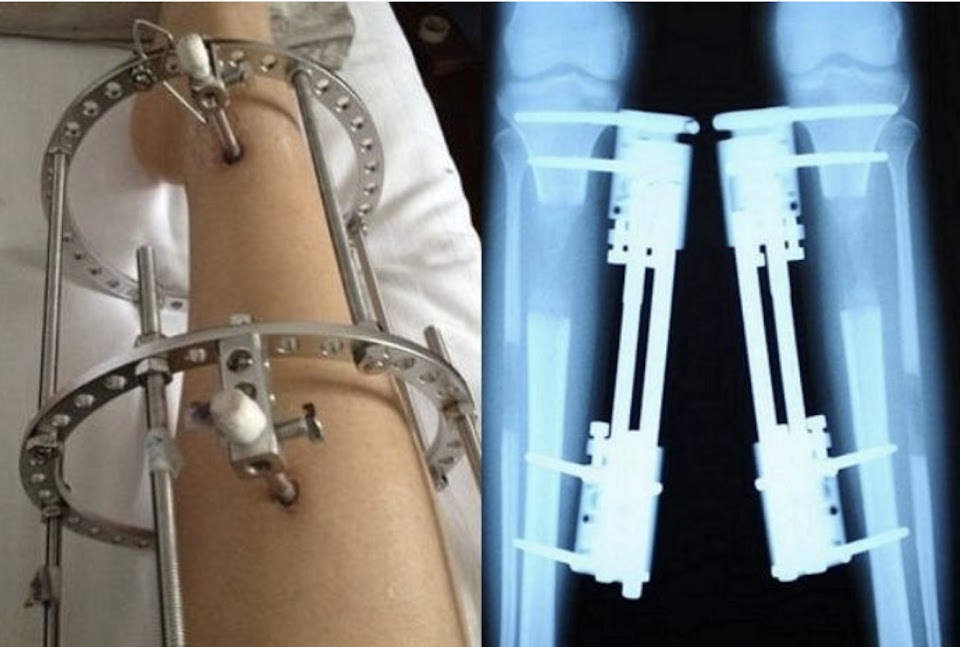 Une fille subit une chirurgie d'allongement des jambes pour grandir de